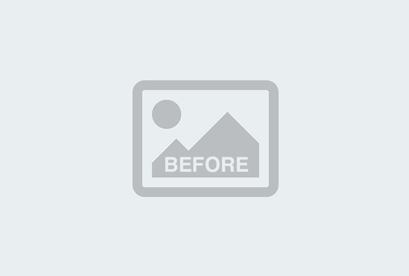 Before Image: Inner thigh lift - 