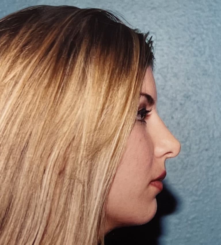 After Image: Rhinoplasty - right-side
