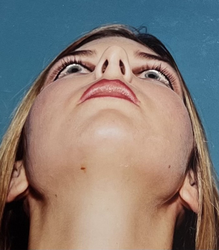 After Image: Rhinoplasty - front