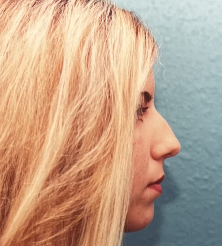 Before Image: Rhinoplasty - right-side