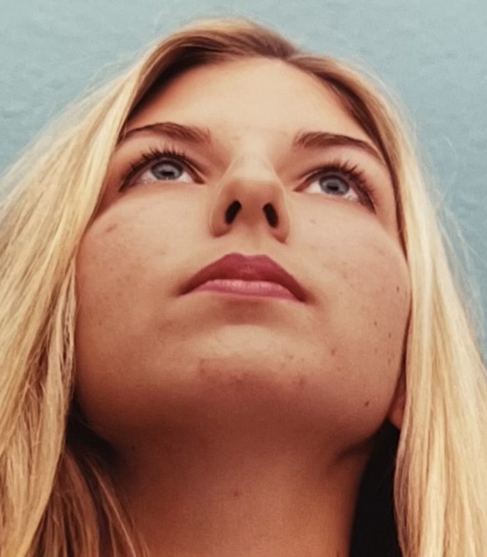 Before Image: Rhinoplasty - front