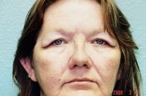 Before Image: Blepharoplasty