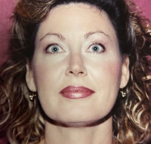 After Image: Facelift