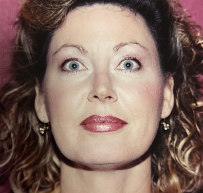 After Image: Facelift - front