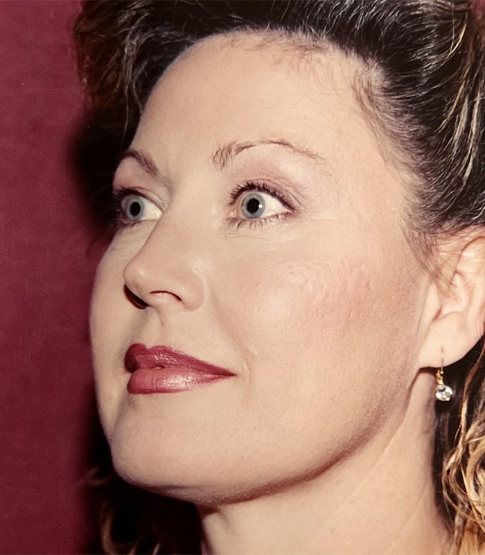 After Image: Facelift - left-front-oblique