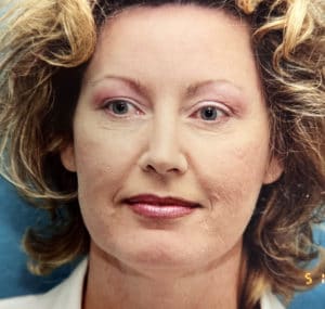 Before Image: Facelift
