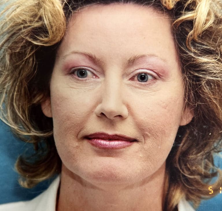 Before Image: Facelift - front