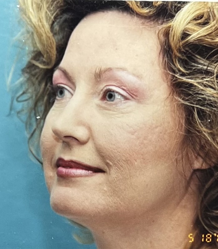 Before Image: Facelift - left-front-oblique