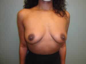 Before Image: Breast Augmentation
