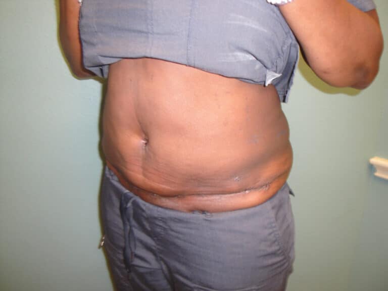 After Image: Tummy Tuck - left-front-oblique