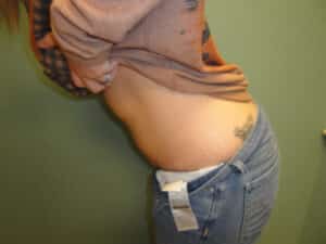 Tummy Tuck