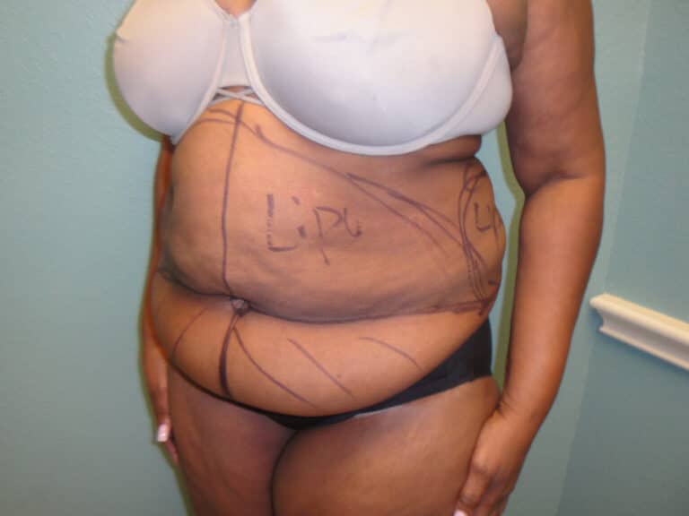 Before Image: Tummy Tuck - left-front-oblique