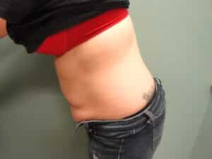 Tummy Tuck