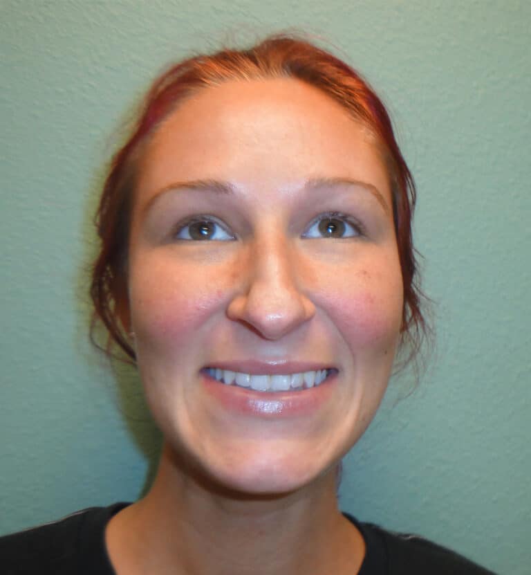 After Image: Rhinoplasty - front