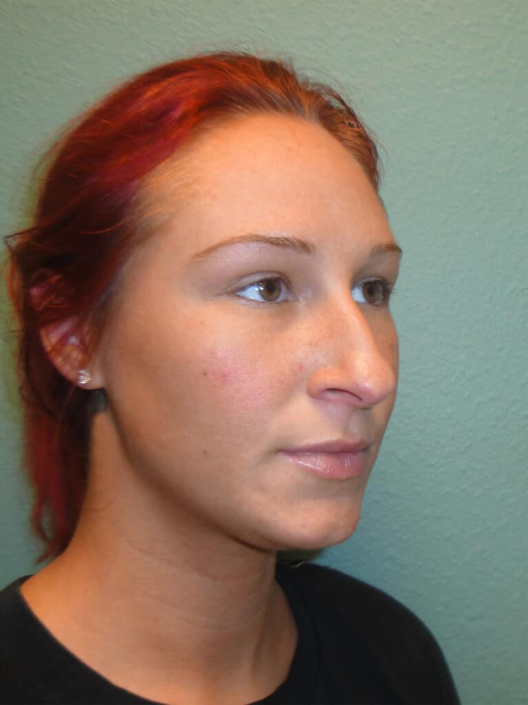 After Image: Rhinoplasty - right-front-oblique