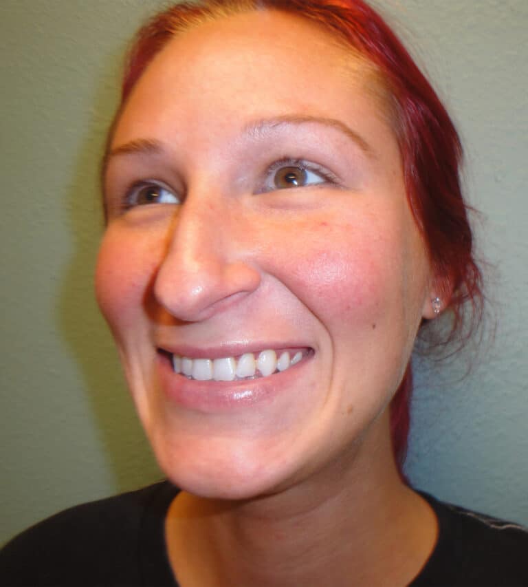 After Image: Rhinoplasty - left-front-oblique