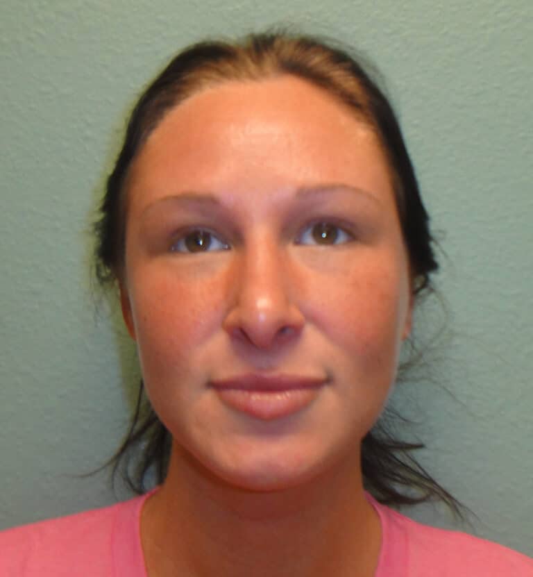 Before Image: Rhinoplasty - front