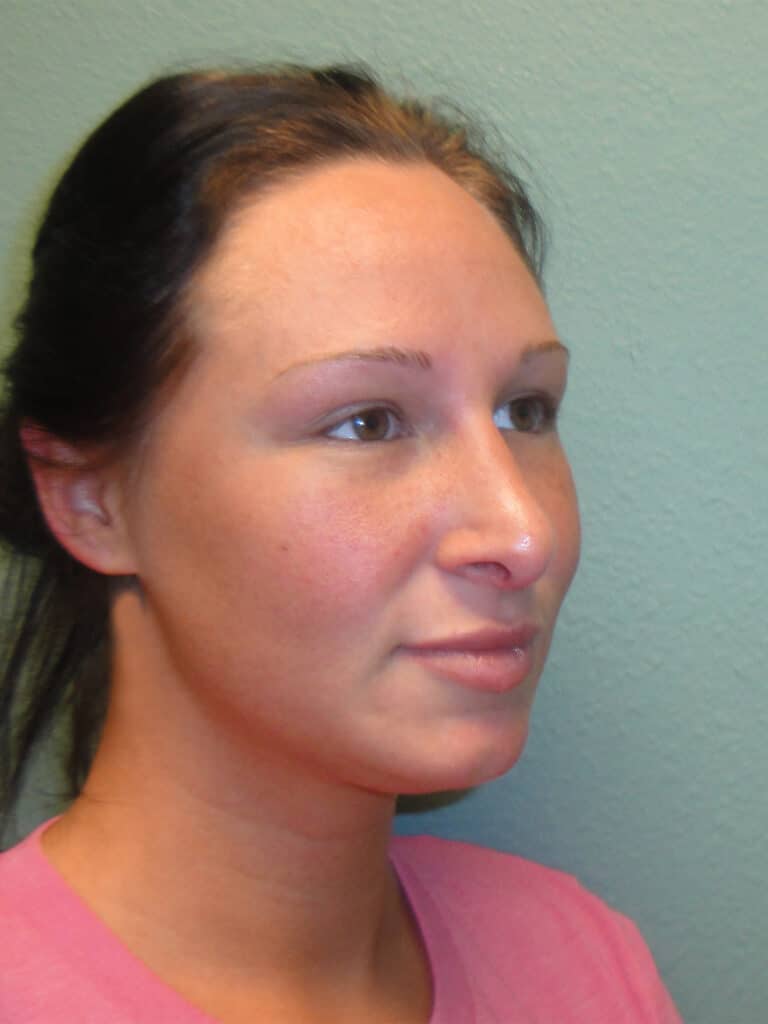 Before Image: Rhinoplasty - right-front-oblique