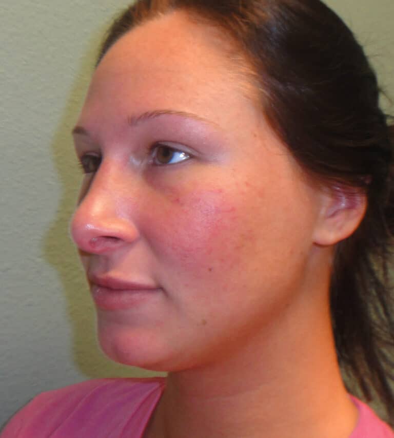 Before Image: Rhinoplasty - left-front-oblique
