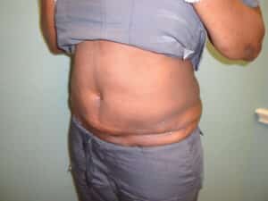 Tummy Tuck After DSC09513