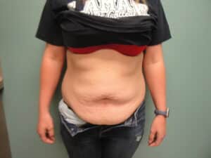 Tummy Tuck DSC08733